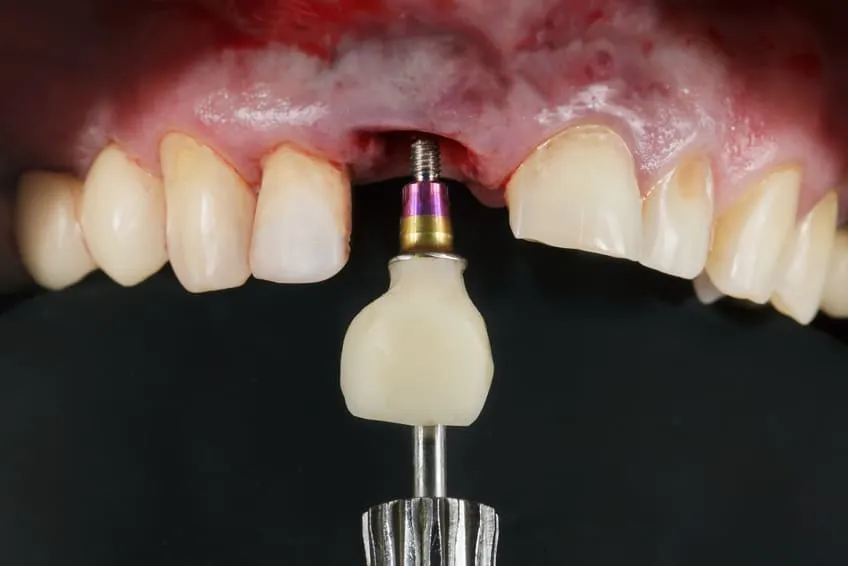 Zalety implantów.